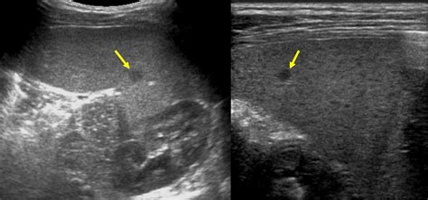 Radiographic Features Of Patients With Chronic Granulomatous Disease