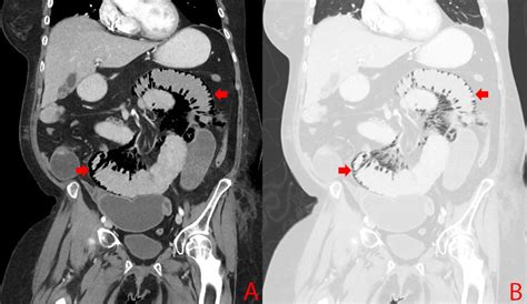 Pneumatosis Intestinalis In Small Bowel Obstruction Bmj Case Reports