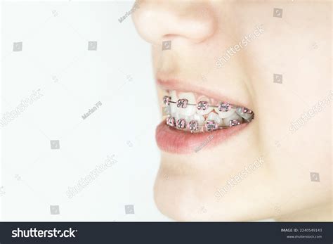 1,409 Rubber Braces Teeth Images, Stock Photos & Vectors | Shutterstock