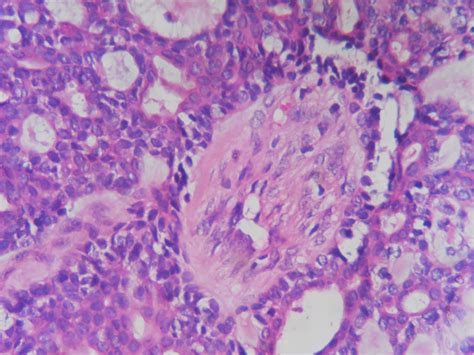 Adenoid Cystic Carcinoma Histopathologyguru