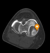 Medial meniscus : Body - e-Anatomy - IMAIOS