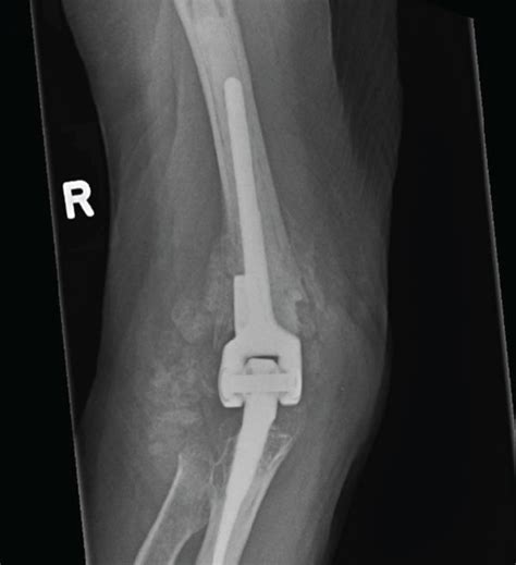 A B Marked Heterotopic Ossification Ho Seen Around The Prosthesis Download Scientific