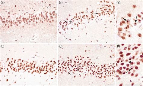 Tar Dna Binding Protein 43 Tdp 43 Pathology In Dentate Gyrus Dg In