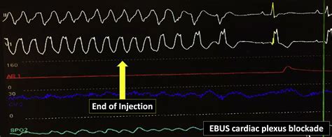 Endobronchial Ultrasoundguided Transtracheal Cardiac Plexus