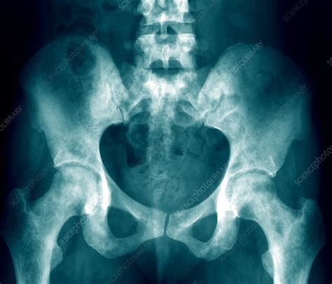 X Ray Of The Pelvis Purpose Procedure And Risks 48 OFF