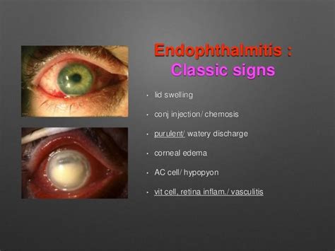 Tass Vs Endophthalmitis