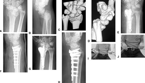 Figure From Corrective Osteotomy For Volarly Malunited Distal Radius