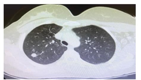 A Subpleural Nodule Of 4 Mm In Diameter In The Middle Lobe Of The Right Download Scientific