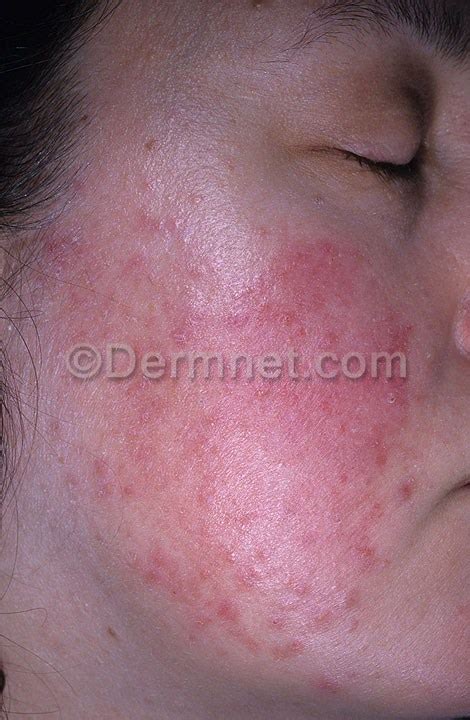 Tinea Ringworm Face Photo Skin Disease Pictures