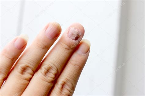 Infección por hongos en las uñas mano dedo con onicomicosis enfoque