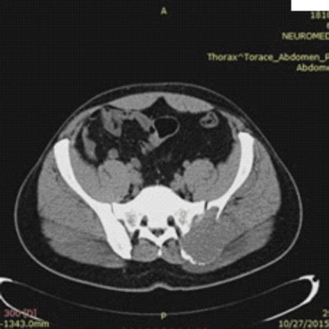 Male 27 Years Old Right Iliac Sacral Osteosarcoma A Positive Download Scientific Diagram