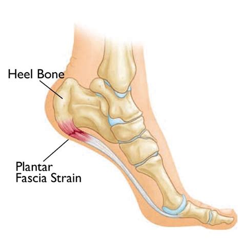 What Is Plantar Fasciitis Foot Health Advice Common Foot