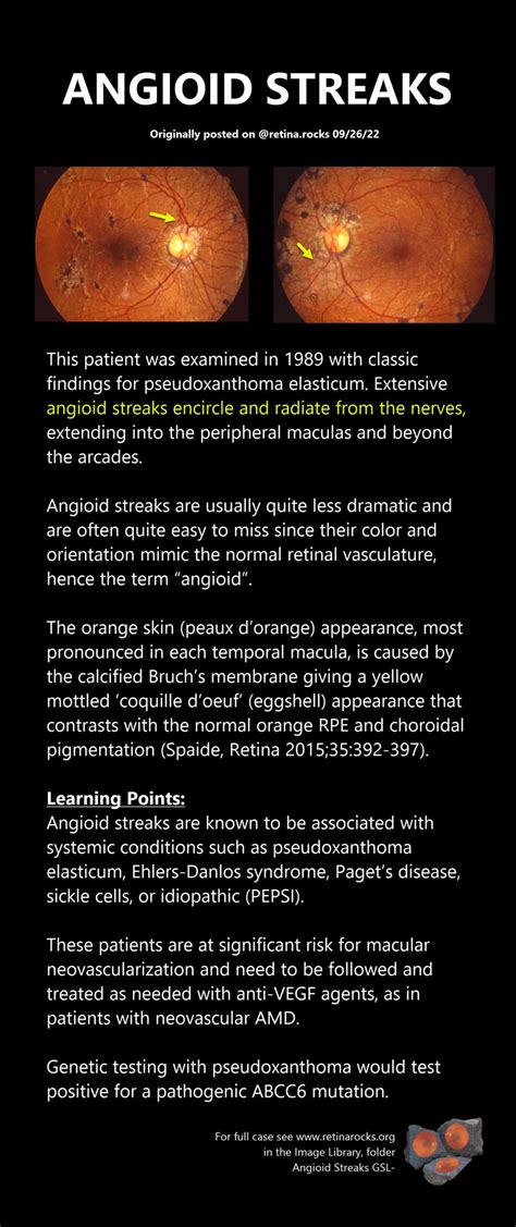 Angioid Streaks Of The Retina