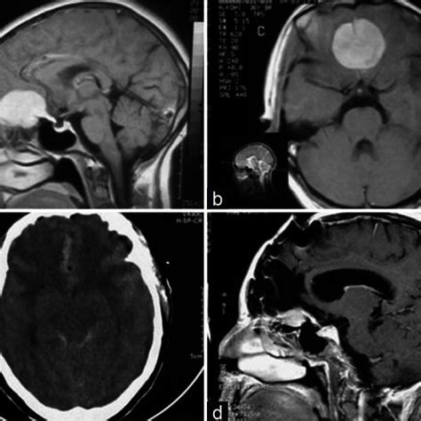 A And B Pre Operative Sagittal And Axial T1 Weighted MRI With