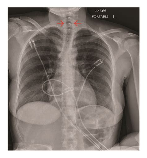 Hospital Day Anterior Posterior Portable Chest Radiograph Sexiz Pix