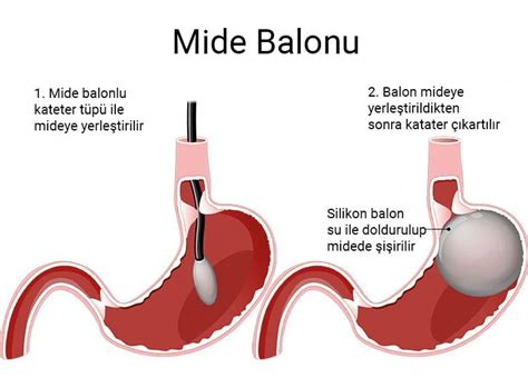 Mide Balonu Nedir Ve Nas L Kullan L R