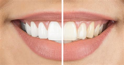 The Best Ways To Whiten Your Teeth My Kind Red Life