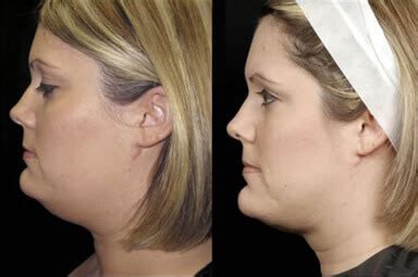 Chin Liposuction Aqualipo Before And After Photos