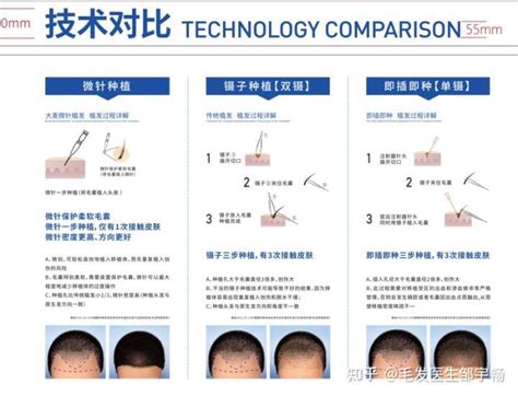 大麦微针植发技术真的靠谱吗？植发效果怎么样？ 知乎