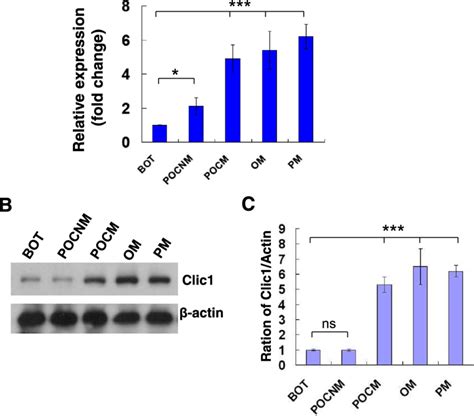 A Qrt Pcr Assay Of Clic Levels In Benign Ovarian Tumor And