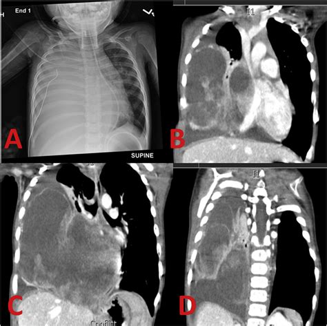 Presentation Of Massive Pleuropulmonary Blastoma With Extension Into