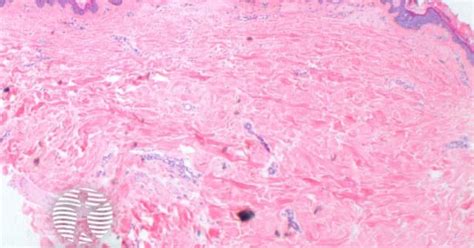 Primary Cutaneous Amyloidosis Pathology Image