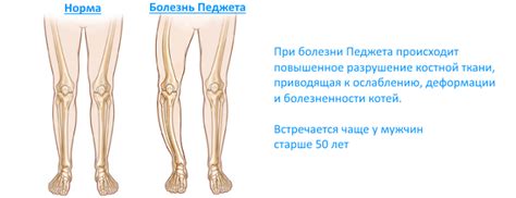 Остеосцинтиграфия - что это такое и как ее проводят