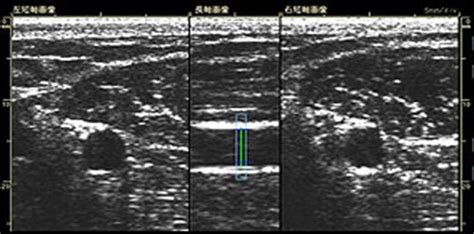 Representative ultrasound image of the brachial artery. Both side... | Download Scientific Diagram