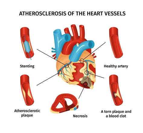 Know Link Between Atherosclerosis And Heart Disease Dr Raghu