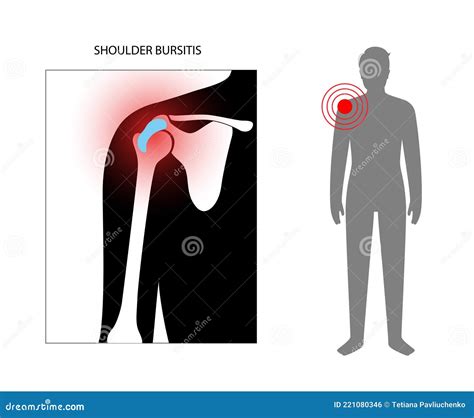 Bursitis Inflammation Concept Stock Vector - Illustration of medical ...