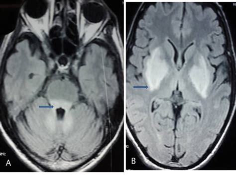 Wernickes Encephalopathy Typical Disease With An Atypical