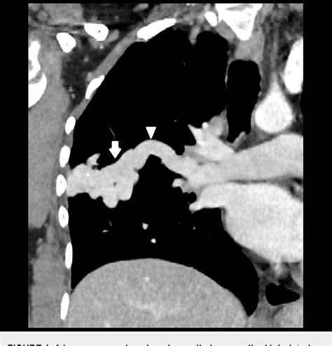 Figure From Endovascular Embolisation Of Pulmonary Arteriovenous