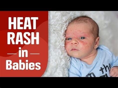 Heat Rash In Babies YouTube Heat Rash On Face Baby Heat Rash Baby