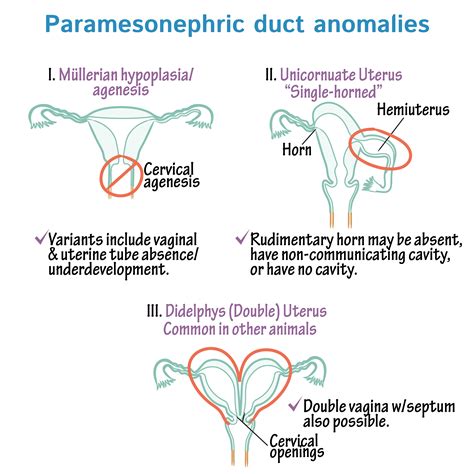 Embryology Glossary Paramesonephric Duct Anomalies Draw It To Know It