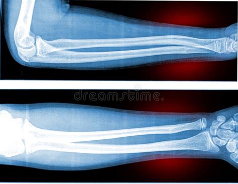 Eje De La Fractura De La Demostración Del Antebrazo Ap De La