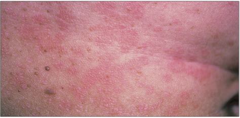 How Would You Treat This Pruritic Rash Consultant360