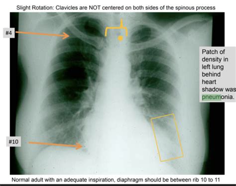 Pulmonology Flashcards Quizlet