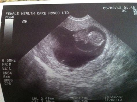 Baby Pulver!!!: 9 weeks & 3 days ultrasound