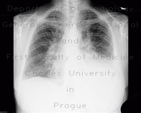 Radiology Case Lymphangitic Carcinomatosis Fluidothorax