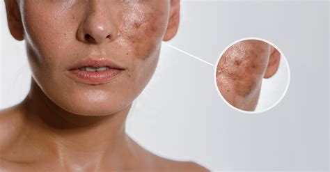 Hyperpigmentation Acne