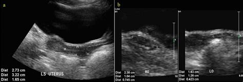 Turners Syndrome Ultrasound