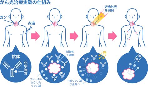 がん治療の新たな選択肢「光免疫療法」