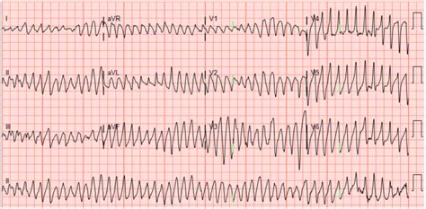 Emergency Medicine Educationecg Pointers Atrial