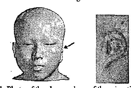 Figure 1 From Development Of Computer Aided Retained Auricular