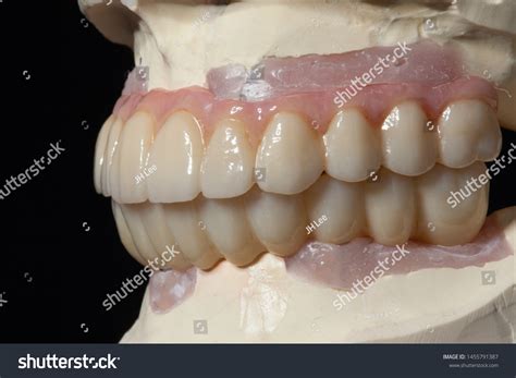 Full Arch Full Milled Zirconia Implant Stock Photo 1455791387