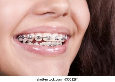 Dental Braces Stock Photo 63361294 | Shutterstock