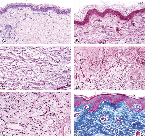 Histopathology Of Cutaneous Aging The American Journal Of