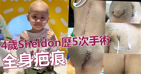 4歲sheldon歷5次手術從容面對 母心痛：細小身軀滿布疤痕 星島日報