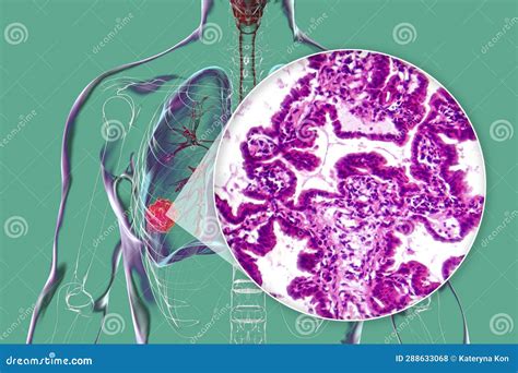 Lung Adenocarcinoma Light Micrograph Royalty Free Stock Photo