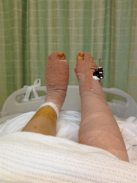 Living With Brachymetatarsia And Coping With Surgery Post Op